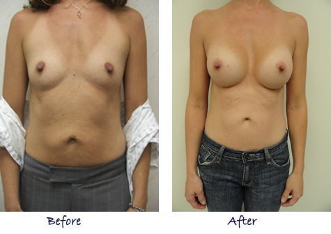 Breast Augmentation