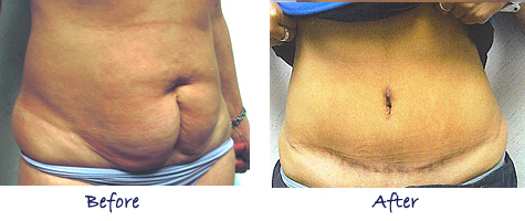 Tummy Tuck