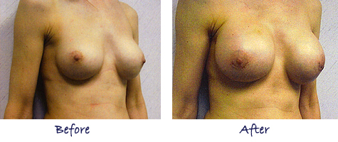 Breast Augmentation