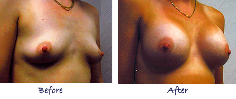 Breast Augmentation