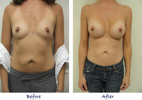 Breast Augmentation