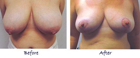 Breast Reduction