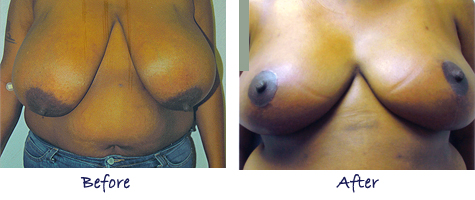 Breast Reduction